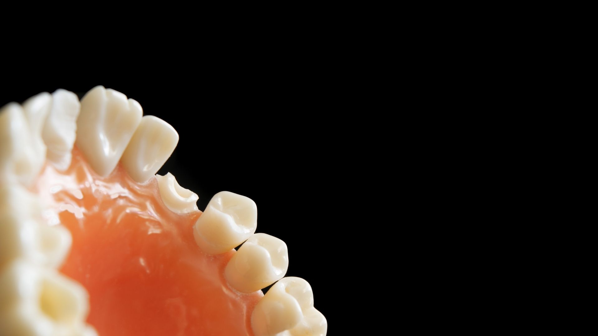 Cirkónium korona a MyDent Fogászatnál